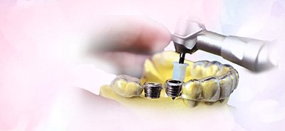 Máng hướng dẫn phẫu thuật